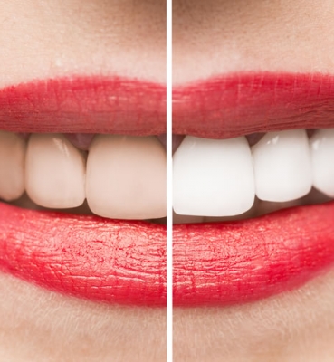 Mitos y realidades sobre el Blanqueamiento dental