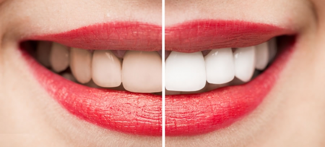 Mitos y realidades sobre el Blanqueamiento dental