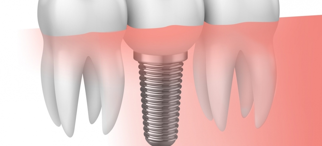 ¿En qué consisten los implantes dentales?